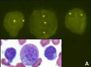 Hematolymphoid Tumors