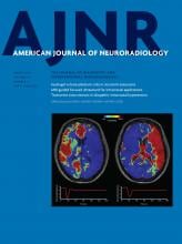 Differences in Hemodynamics and Rupture Rate of Aneurysms at the Bifurcation of the Basilar and Internal Carotid Arteries