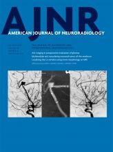 Hemodynamic Characteristics of Ruptured and Unruptured Multiple Aneurysms at Mirror and Ipsilateral Locations