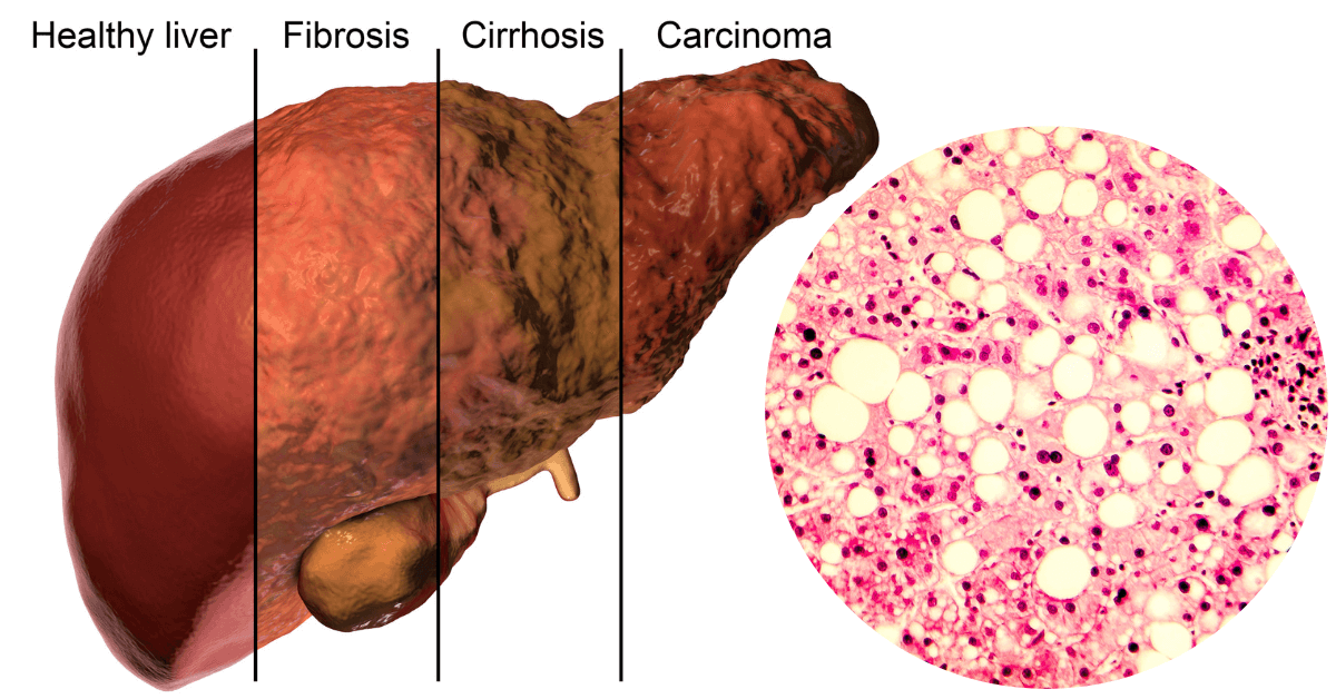 Michael Czech Lab Nonalcoholic Steatohepatitis 