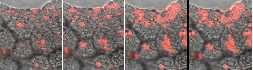 RSV infection of lungs