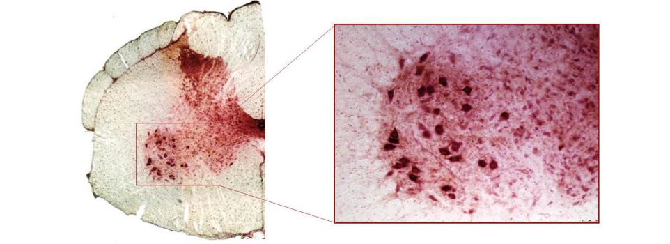 Amyotrophic Lateral Sclerosis, SOD1-associated