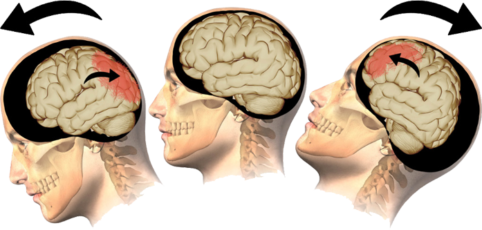 Brain Injury Types