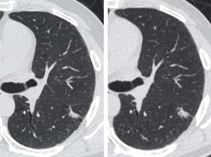 LDCT Lung Screening 2