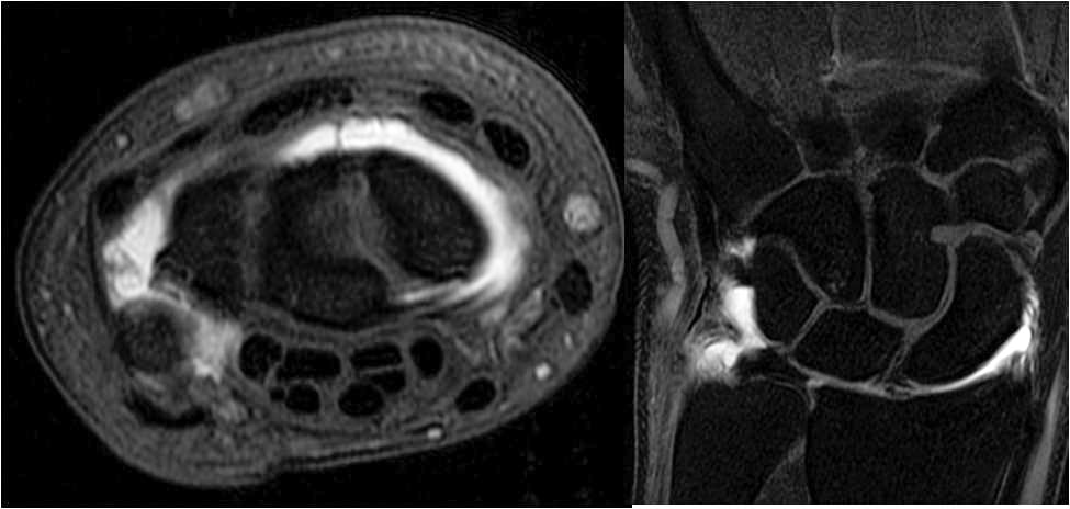 UMass Chan Radiology - MSK Fellowship Research