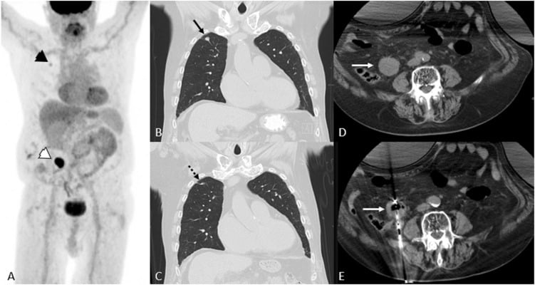 IR oncology update