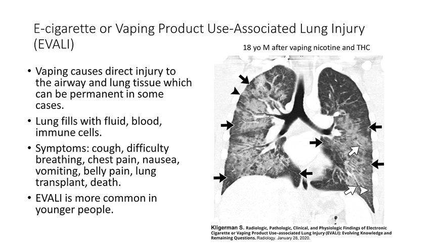 Lungs and vaping