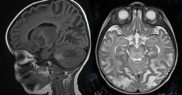 canavan-disease