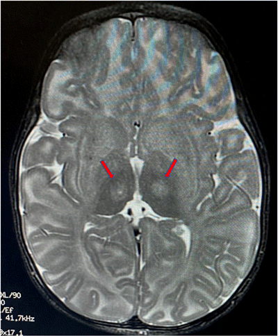 tay-sachs-brain-scan-400.gif